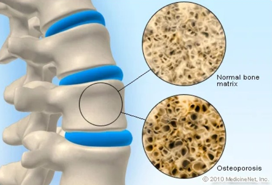 Bone Health Awareness